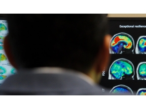 フロンティア　認知症“克服のカギ”を求めて